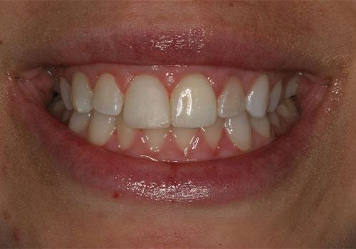 Before & After Gallery | Dentist Davidson, NC